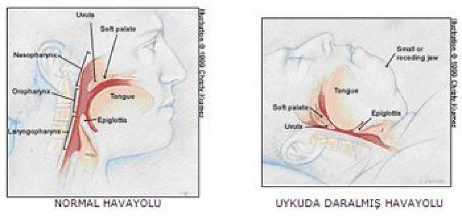 UYKU APNESİNDE TANI VE TEDAVİ PRENSİPLERİ