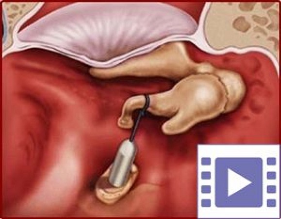 KULAK KİREÇLENMESİ - OTOSKLEROZ - TİMPANOSKLEROZ