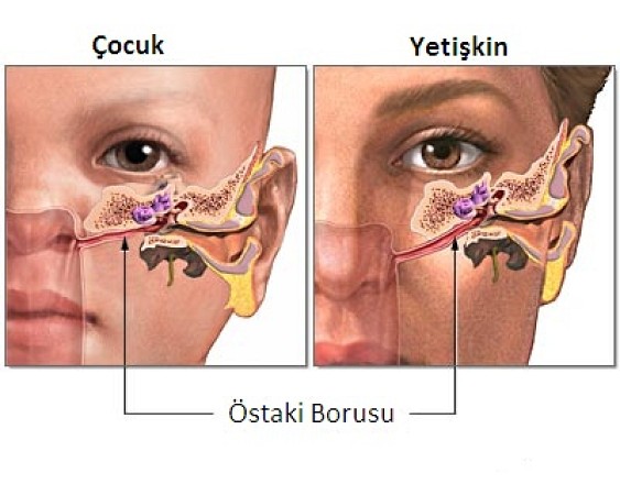 BAROTRAVMA NEDİR? KULAKLARDA BASINÇ ARTIŞI NEDİR?